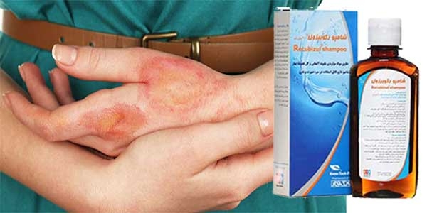 شامپو داروی رکوبیزول، شوینده اختصاصی در کاهش التهاب موضعی، زخم و سوختگی