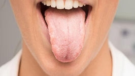 دلایل و علایم خشکی دهان و درمان آن