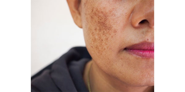 معرفی 2 کرم لایه بردار قوی برای لک صورت