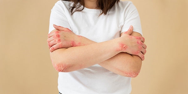 اگزما چیست و چگونه درمان می‌شود؟