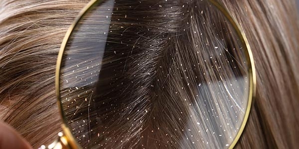 شوره سر چیست؟