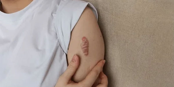 معرفی 3 پماد برای کلوئید پوستی