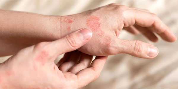 بهترین پماد برای حساسیت پوستی