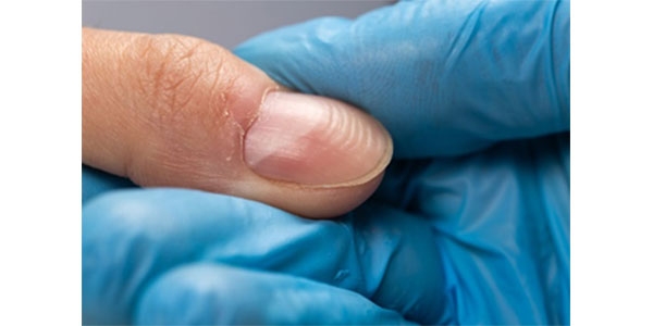 علت موج دار شدن ناخن چیست؟