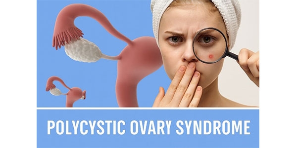 روتین پوستی برای افراد مبتلا به سندرم تخمدان پلی‌کیستیک (PCOS)