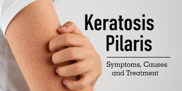 علت و درمان پوست مرغی