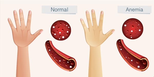 همه چیز در مورد کم خونی