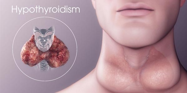 کم کاری غده تیروئید (هیپوتیروییدی)