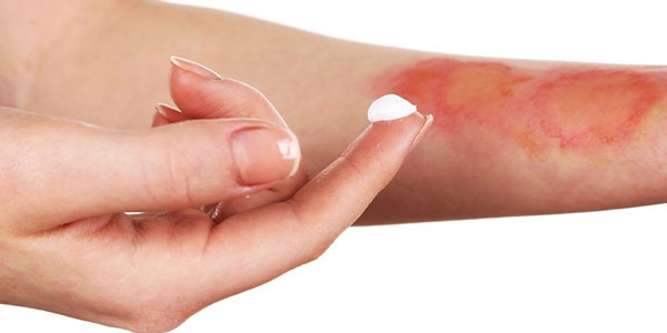 بهترین کرم ترمیم کننده سوختگی درجه 1 و 2