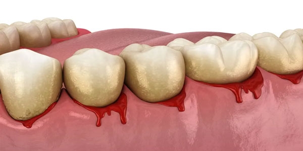 کمبود کدام ویتامین باعث خونریزی لثه می‌شود؟