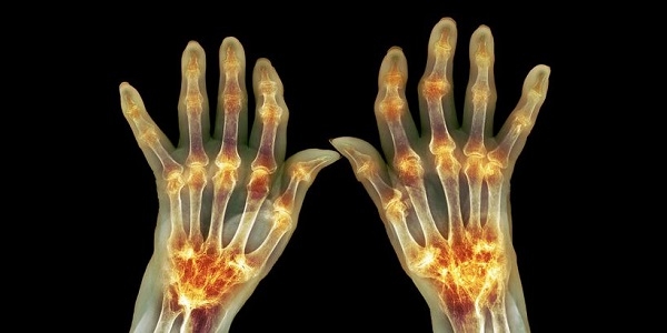 تسکین آرتریت روماتوئید با عصاره زنجبیل