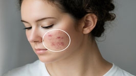 10 روش ساده برای درمان آکنه یا جوش صورت