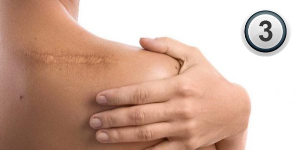 اسکار و راه های درمان آن (قسمت سوم)