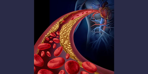 عوامل بالا رفتن کلسترول خون