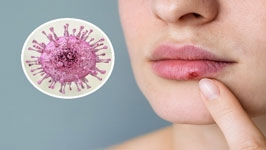 تبخال درمان و پیشگیری