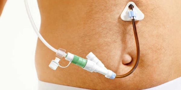 چگونه یک بیمار ژژنوستومی را تغذیه کنیم؟