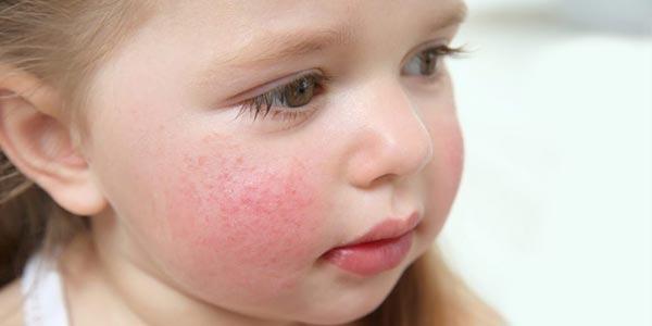 درمان های طبیعی و خانگی برای آلرژی کودکان