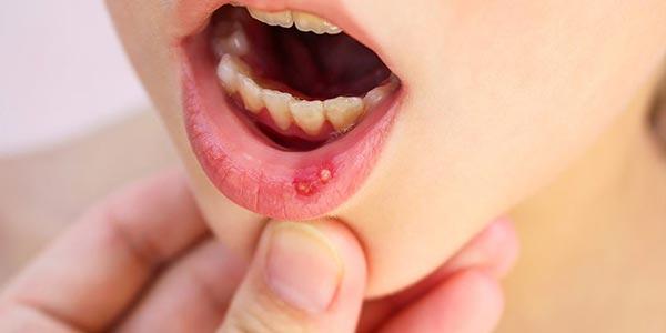 رپورتاژ- درمانی موثر برای آفت دهان