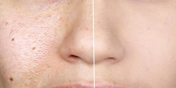 معضل منافذ باز پوست صورت + چند راهکار طلایی برای درمان